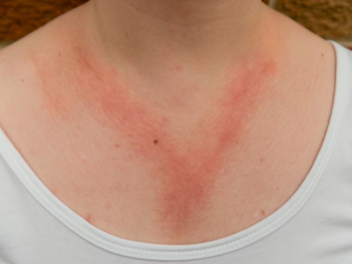 What Are the Different Forms of Dermatitis?